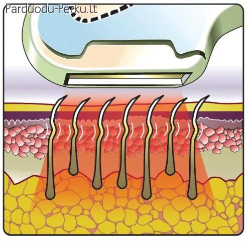 ILGALAIKIS PLAUKELIŲ ŠALINIMAS - FOTOEPILIACIJA